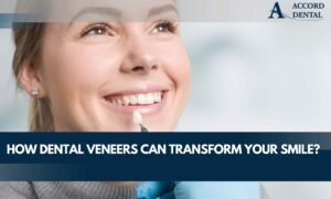 How Dental Veneers Can Transform Your Smile?