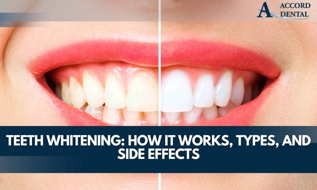 Teeth Whitening: How It Works, Types, and Side Effects