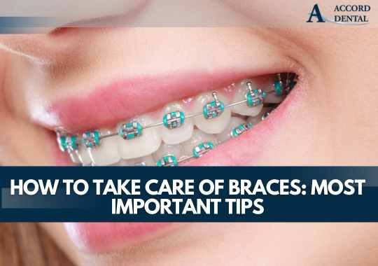 How to Take Care of Braces: Most Important Tips